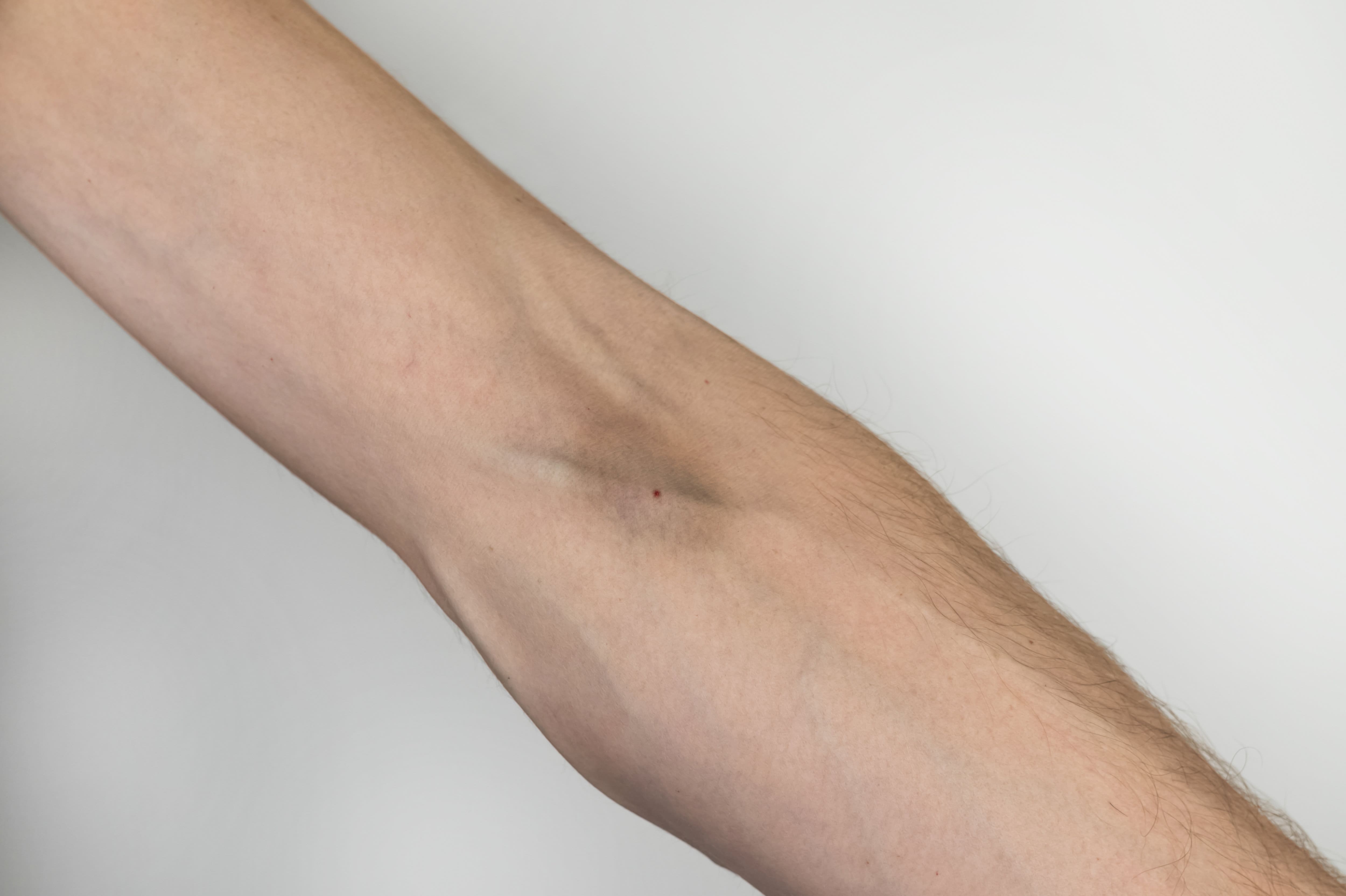 A close up of a man's arm with a bruise on it, possibly from an outpatient program or addiction recovery center.