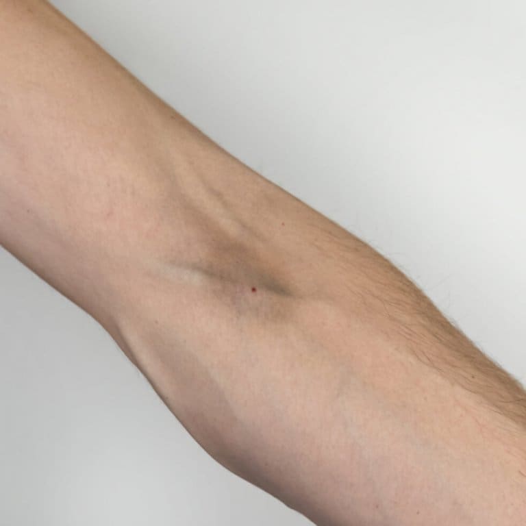 A close up of a man's arm with a bruise on it, possibly from an outpatient program or addiction recovery center.